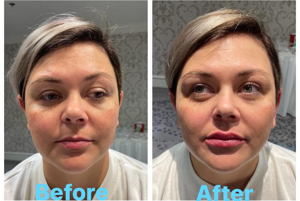 front view of lip filler injections