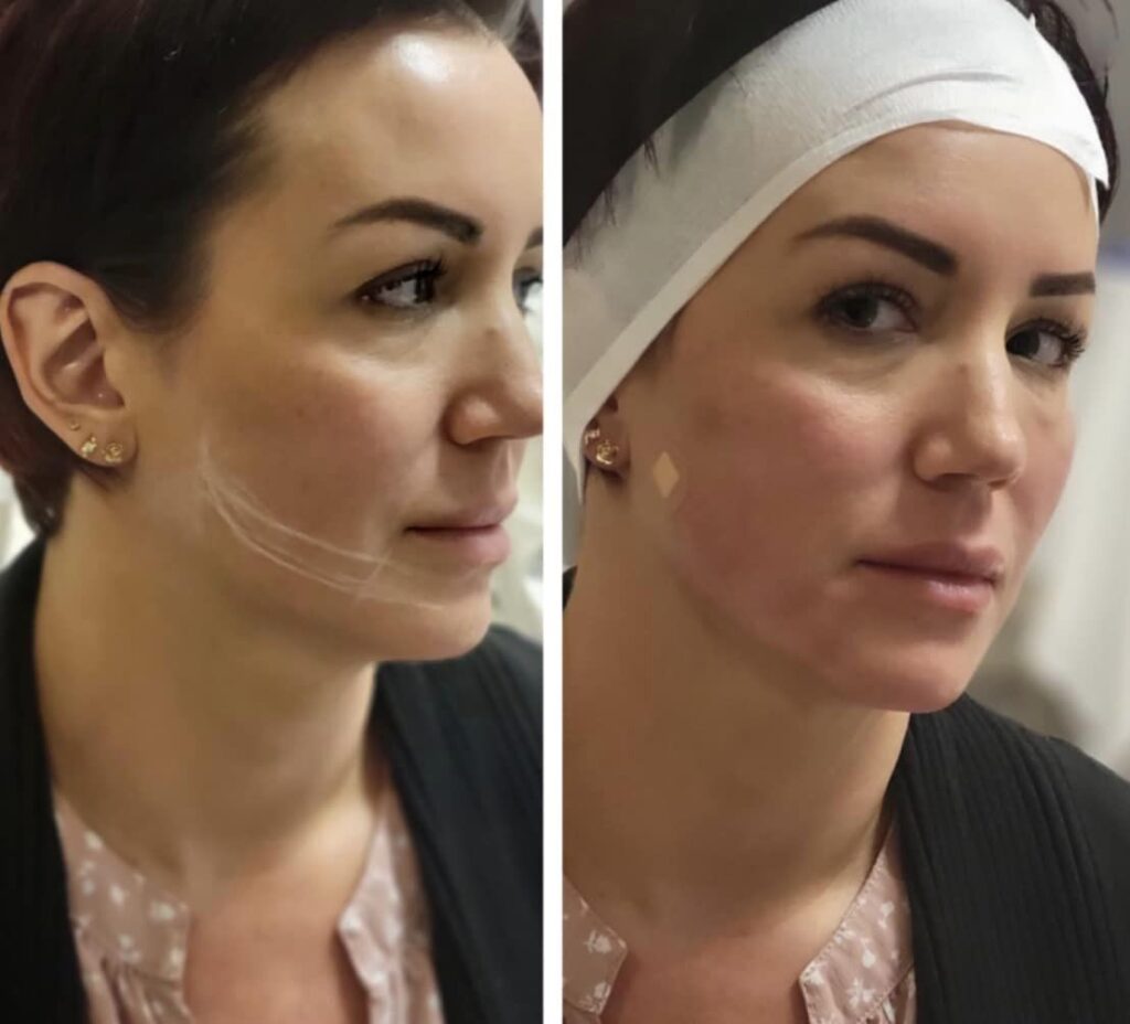 PDO Lifting Threads to lift jawline