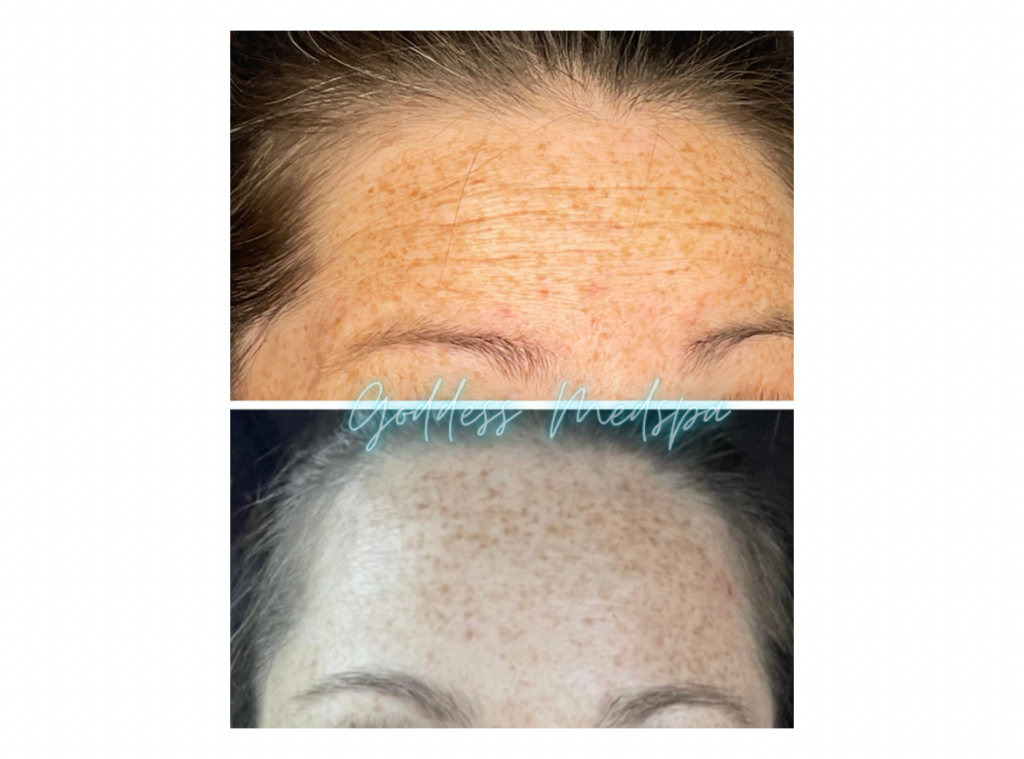 before and after of botox injections