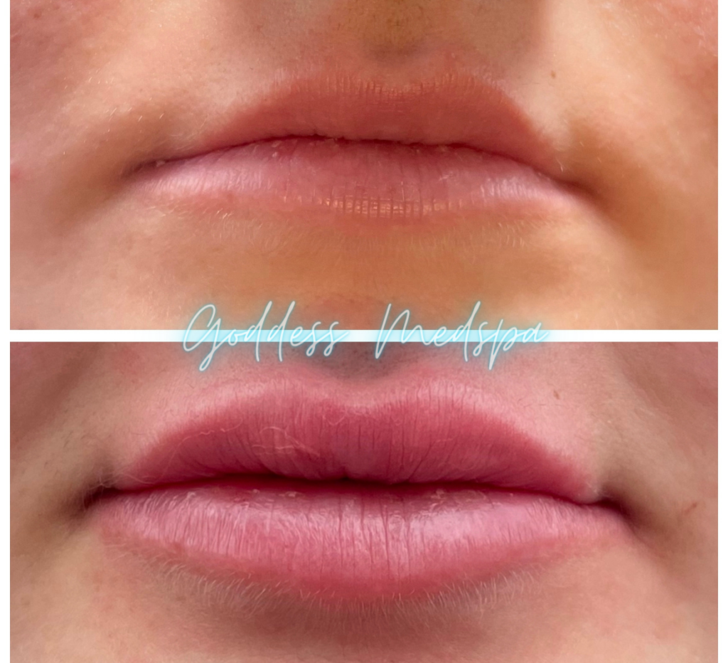 before and after of dermal lip enhancement