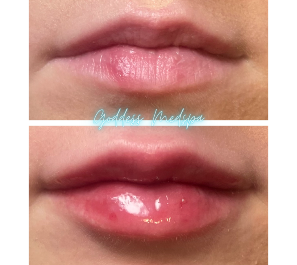 before and after of dermal lip filler