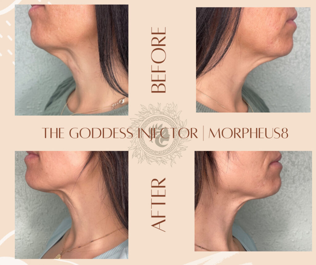 before and after of Morpheus 8 neck treatment