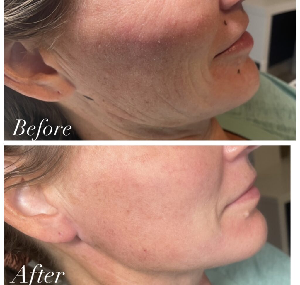 before and after of lifting threads treatment